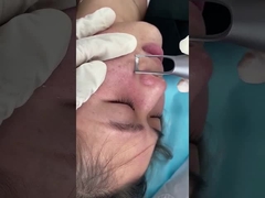 Salon-Picosekunden-Laser-Maschine 1064nm 532nm für Haut-Pigmentations-Verletzungs-Problem-Behandlung