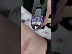 50 W Fractional RF Mikronadelmaschine 100 V bis 240 V